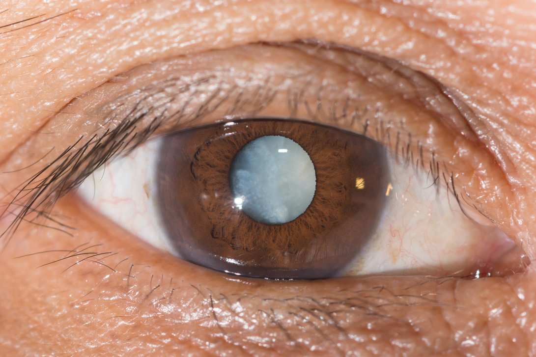 cataract-evaluation-and-surgery-pgheyemeds