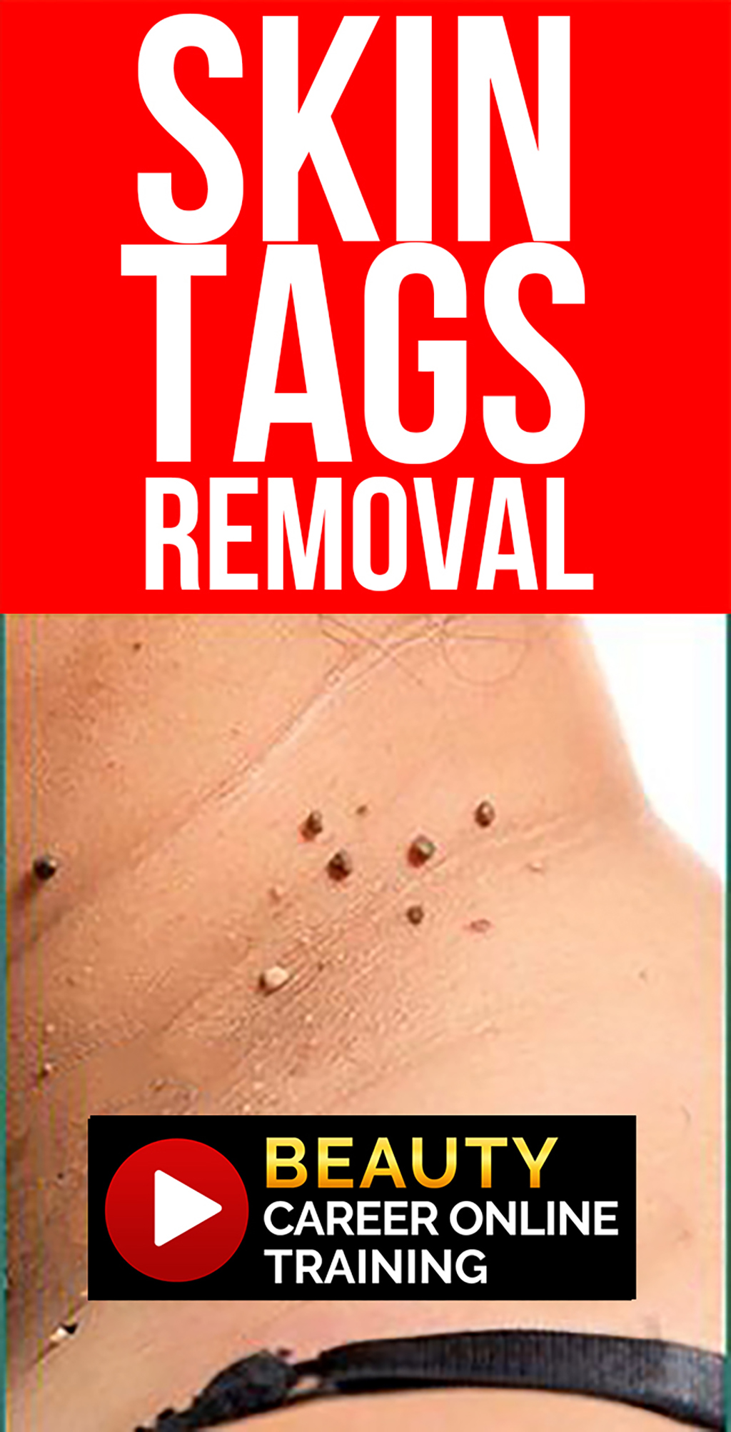  acne, blemishes, pore, age, sun, dark & brown spot diminishing, skin tag & mole removing 