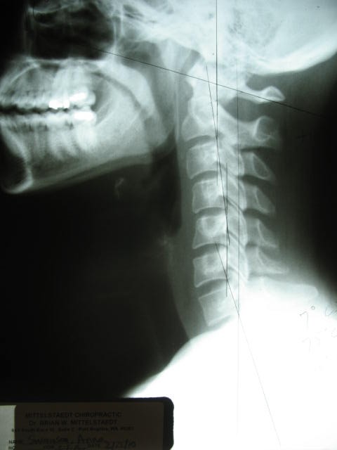 lateral x-ray 2004