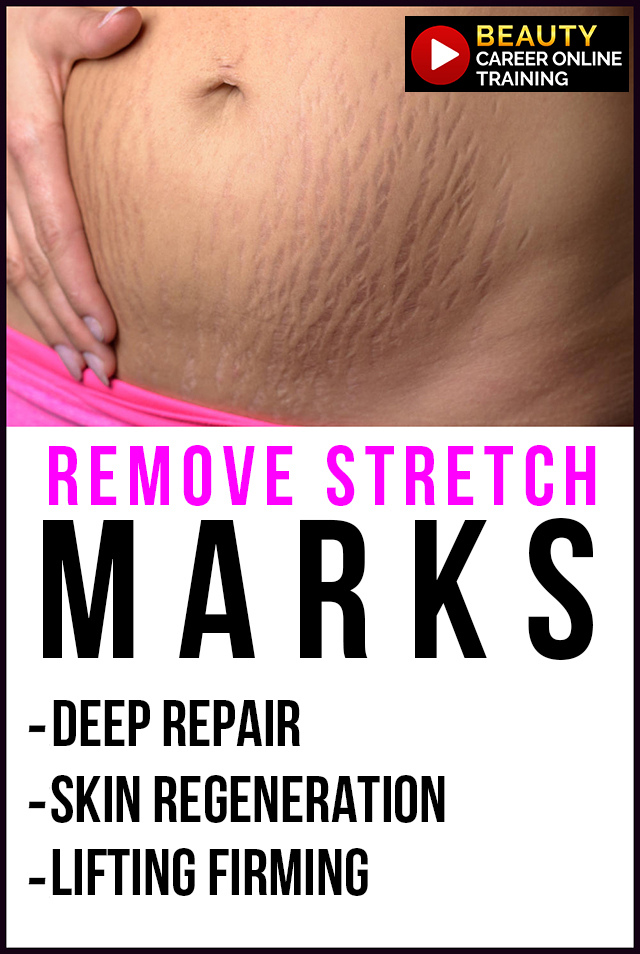 stretch marks, skin tightening, cellulite, plasma pen, skin lift