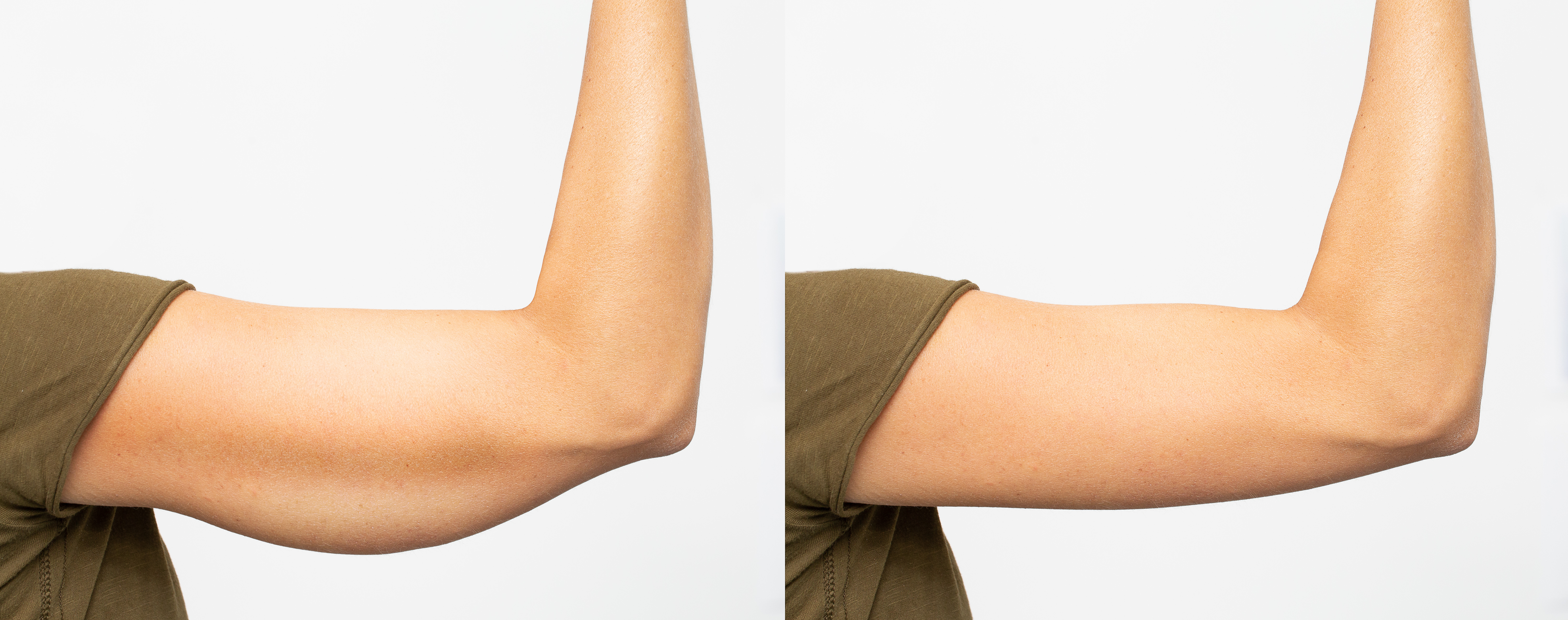 Before and after leaving the Skin of the Arm