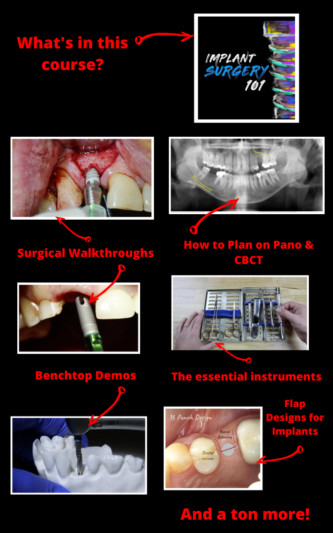 Implant Surgery 101 Dental Student MiniCourse Implant Ninja